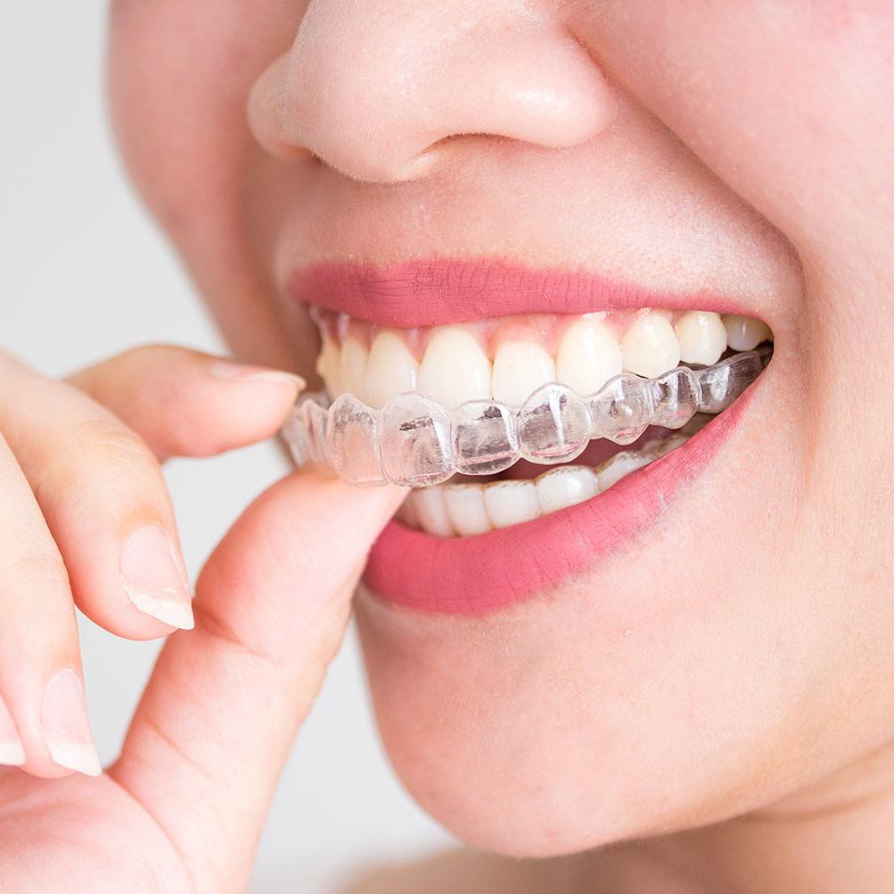 Teeth Whitening With Braces - 2/4pcs Mouth Guard Teeth Protector Guard