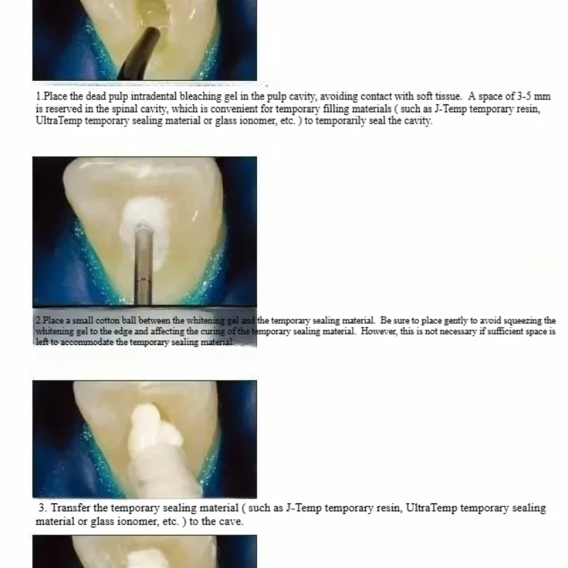 Dental Oral Restoration Materi - đánh giá và giá Teeth Whitening Effects
