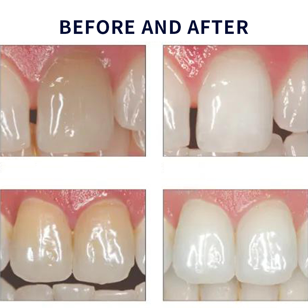 Opalescence Whitening 20% PF 2 - đánh giá và giá Teeth Whitening At Home Kit