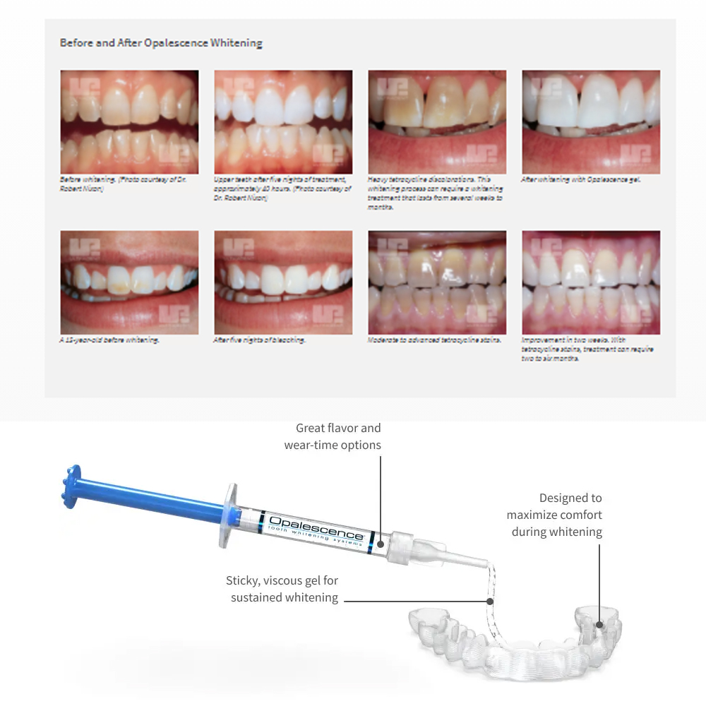 Opalescence Whitening 20% PF 2 - đánh giá và giá Teeth Whitening At Home Kit