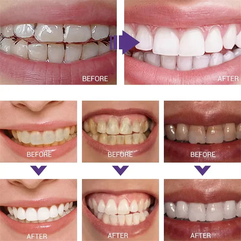 Teeth Cleansing Whitening Toot - đánh giá và giá Teeth Whitening In Korea