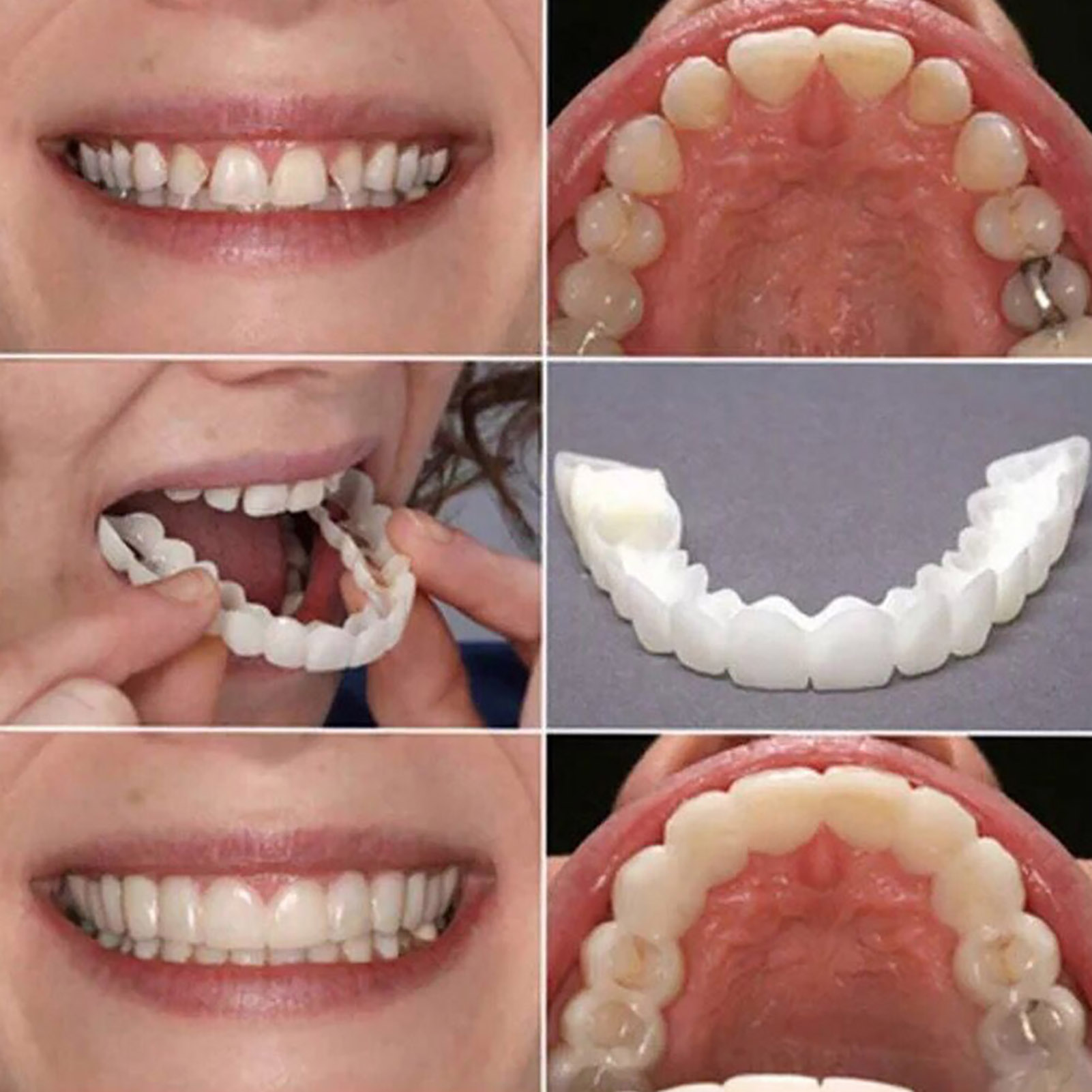 Hot Teeth Veneers Whitening De - đánh giá và giá Teeth Whitening With Braces