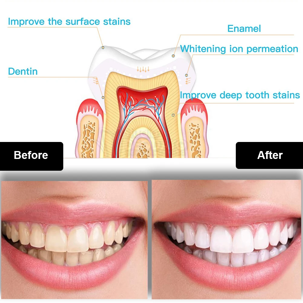 Dental Teeth Whitening Kit Min - đánh giá và giá Teeth Whitening Pen
