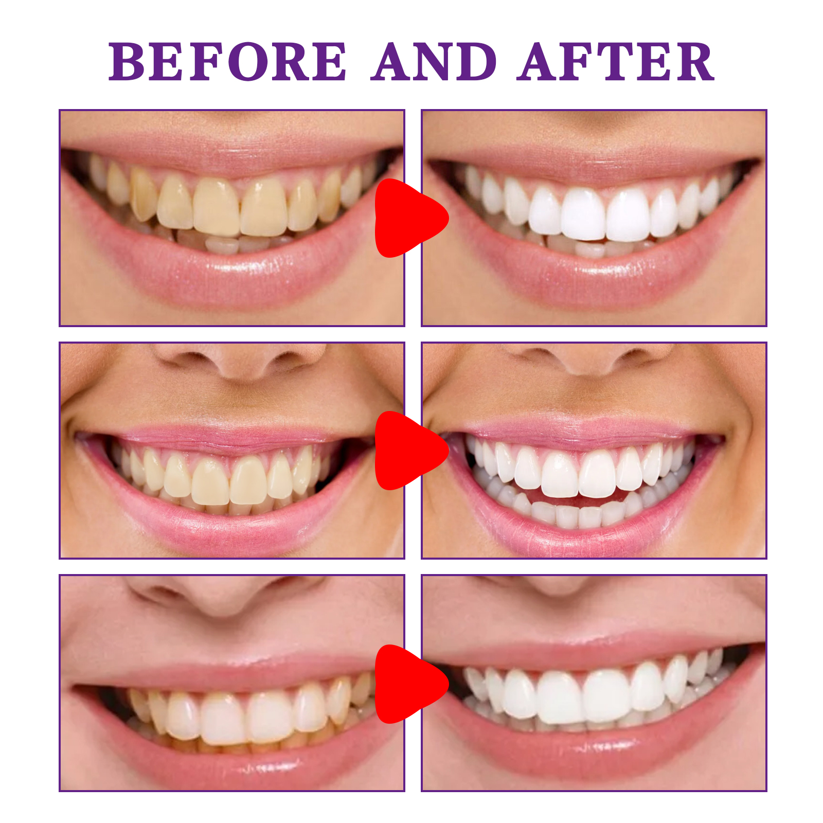 Teeth Cleansing Whitening Toot - đánh giá và giá Teeth Whitening In Korea