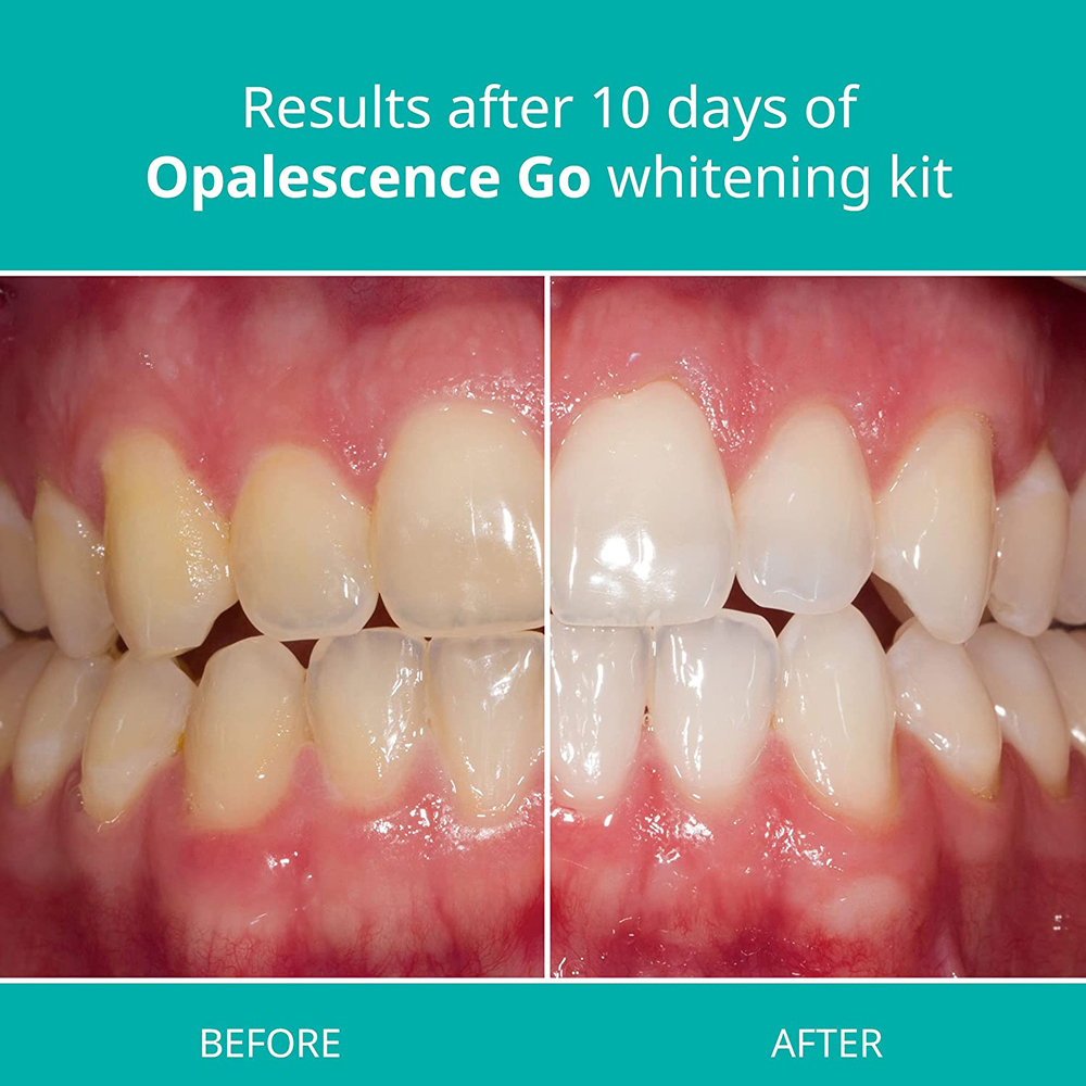 Opalescence Go Teeth Whitening - đánh giá và giá Teeth Whitening At Home Kit