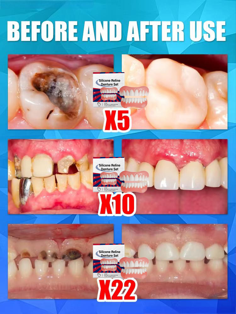 False Teeth Silicone Upper Low - đánh giá và giá Teeth Whitening With Braces