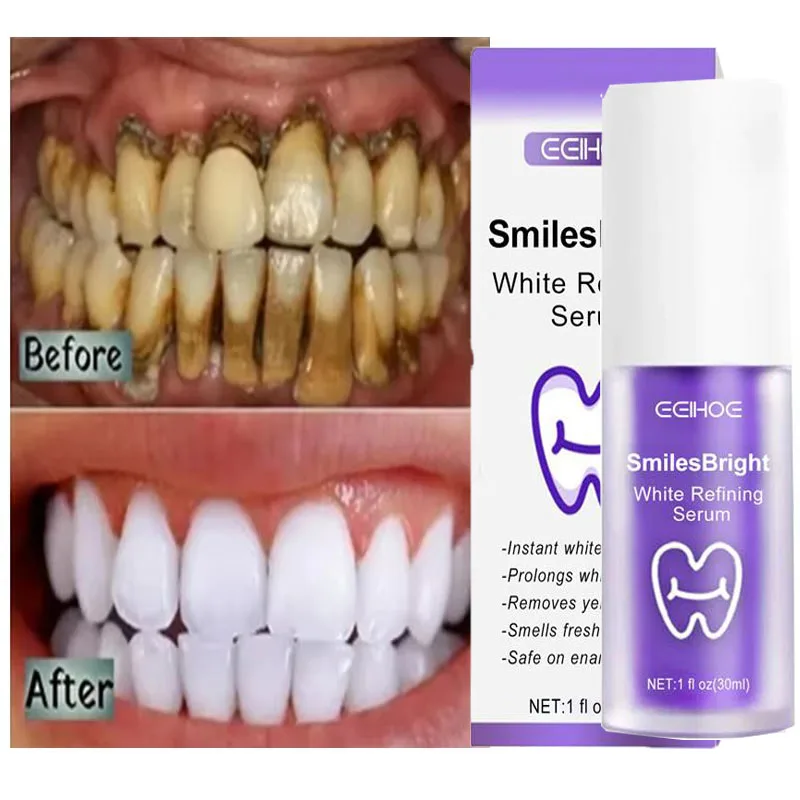 Whitening Toothpaste Teeth Cle - đánh giá và giá Teeth Whitening In Korea